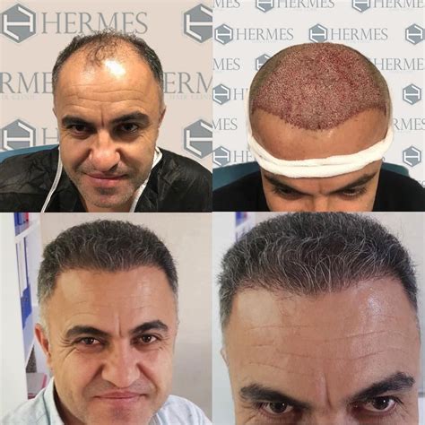 hermes hair clinic saç ekim merkezi istanbul|hermest hair center turkey.